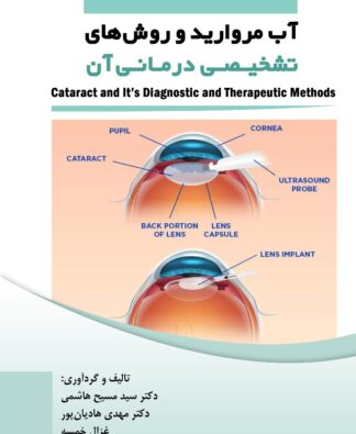آب مروارید و روشهای تشخیصی درمانی آن